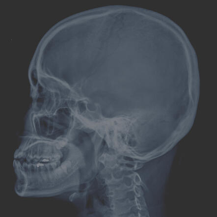 Targets the sphenopalatine ganglion for facial and cluster pain. Office-based and non-sedating.
