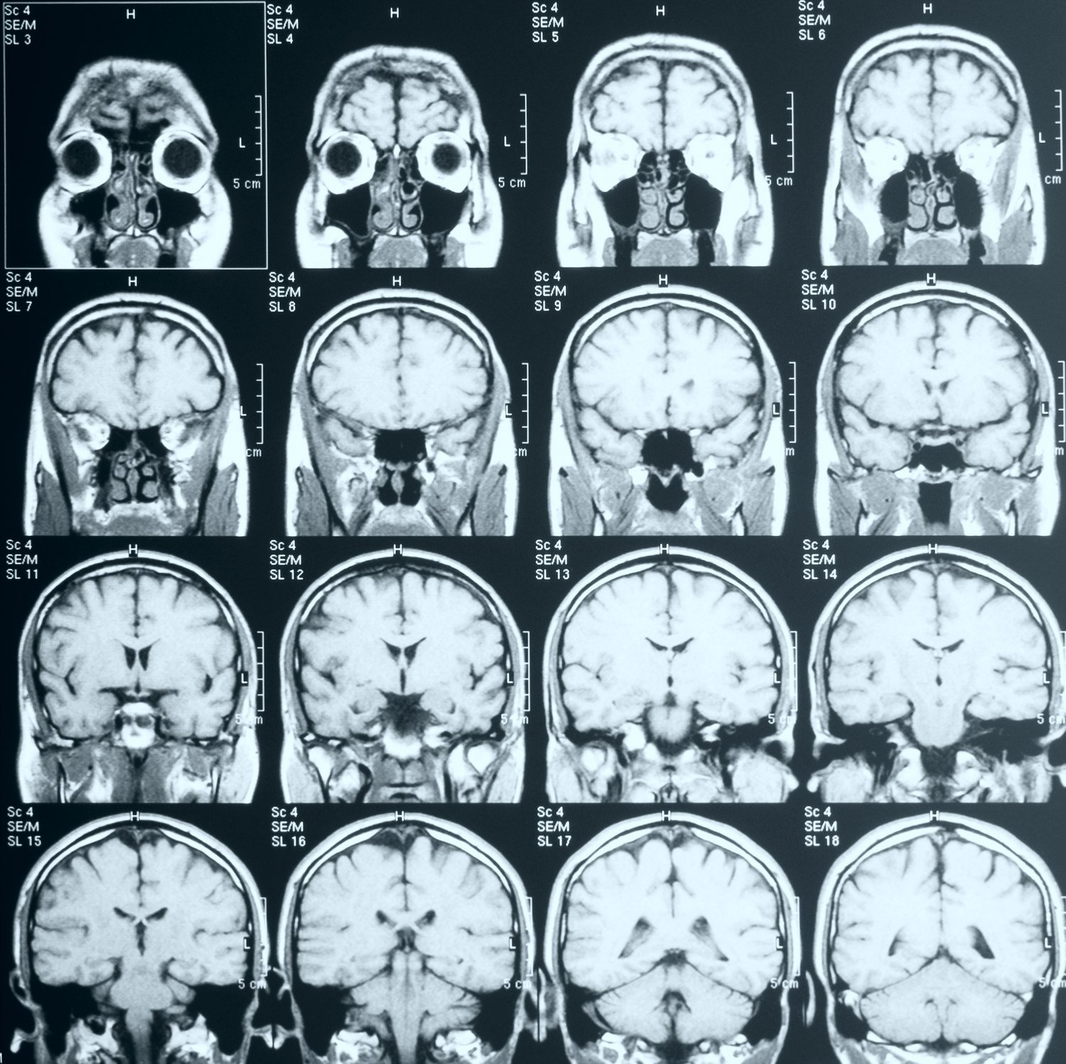 A coronal MRI series of the head, sixteen slices from the front of the orbits back through the cerebellum, of the kind ordered when a headache has a feature that warrants imaging