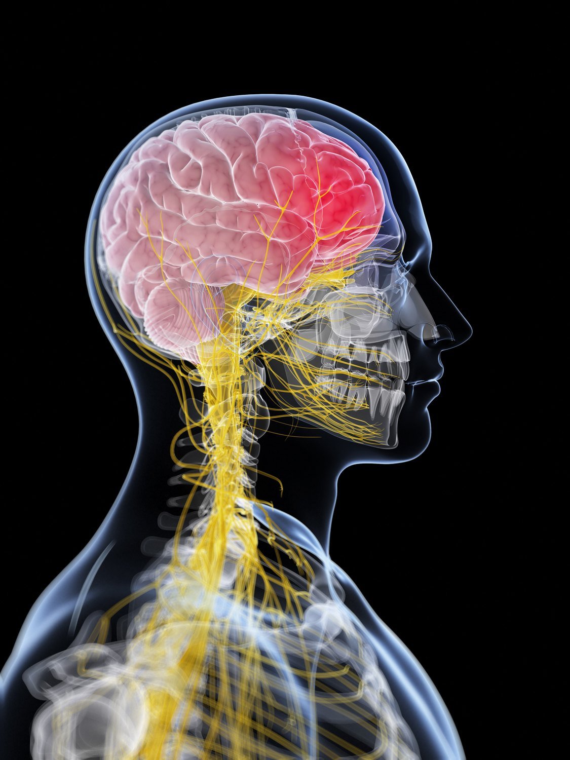 Medical illustration of the head and neck in profile showing cranial and cervical nerve pathways in yellow, with a shaded area of pain across the front of the head
