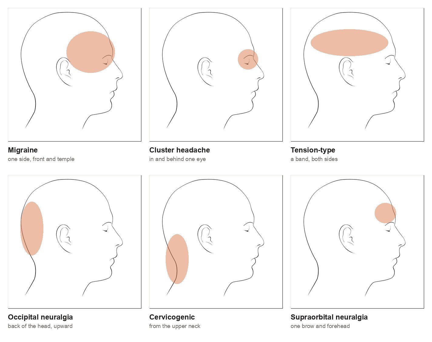 Six head-profile diagrams showing where each headache type is typically felt: migraine over one side and temple, cluster headache in and behind one eye, tension-type as a band across both sides, occipital neuralgia at the back of the head, cervicogenic headache from the upper neck, and supraorbital neuralgia over one brow and forehead