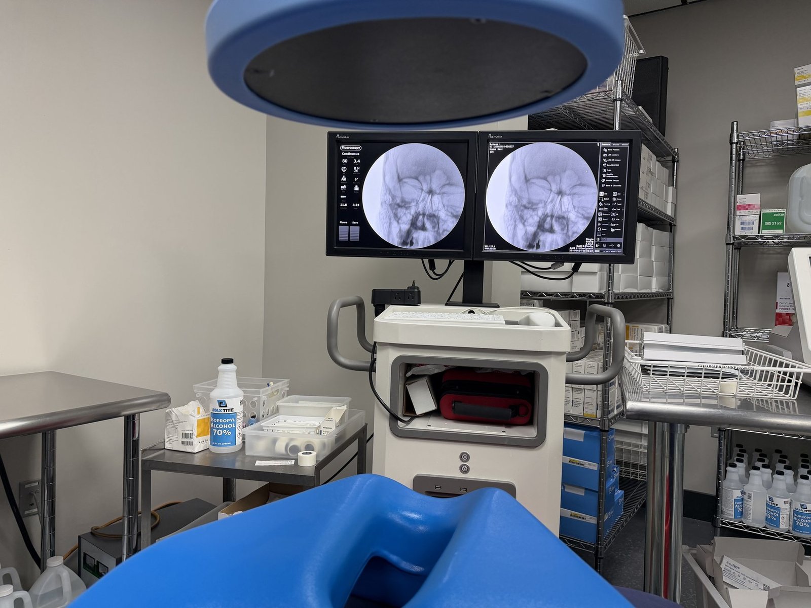 Fluoroscopy suite with dual monitors showing anteroposterior skull views, C-arm and procedure table, used to guide a sphenopalatine ganglion block
