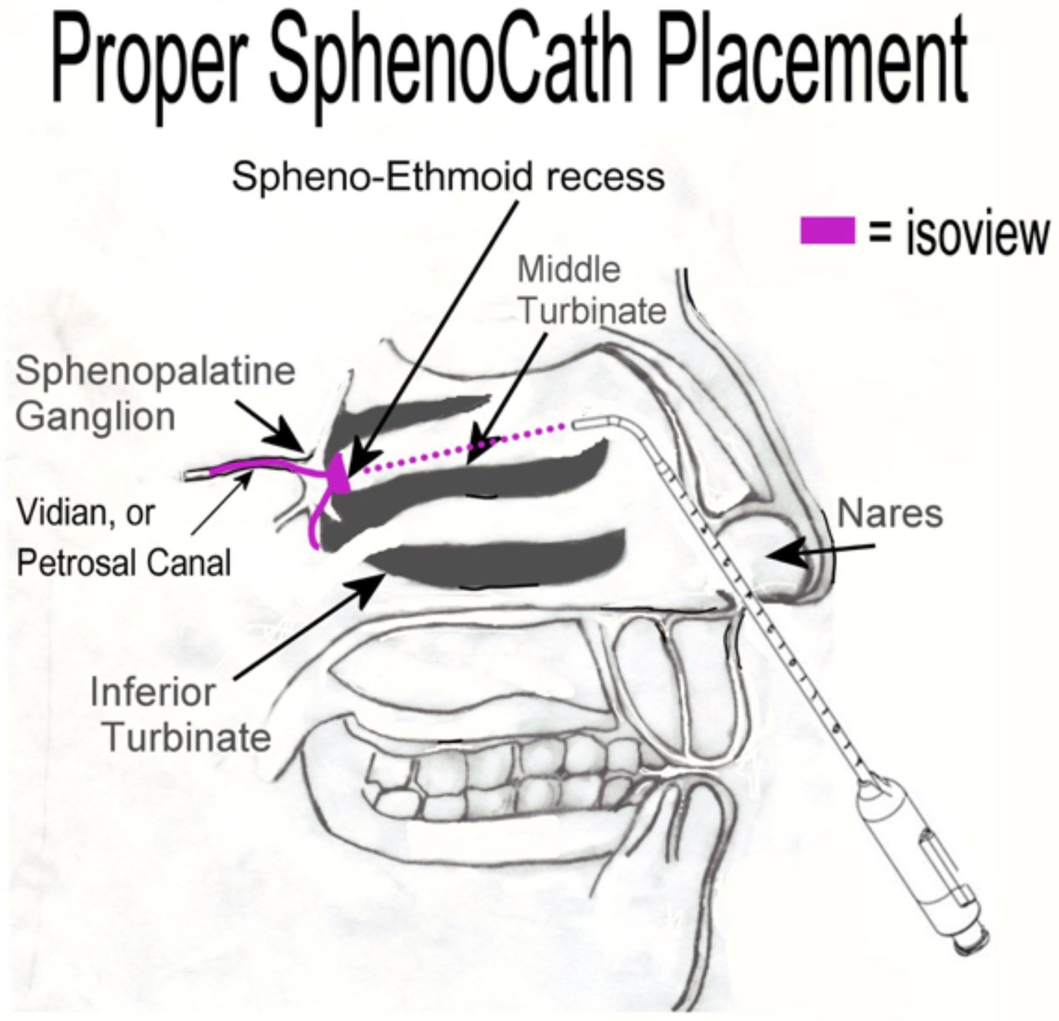 Diagram of correct SphenoCath [soft nasal catheter for sphenopalatine ganglion block] placement, showing the catheter passing below the middle turbinate into the spheno-ethmoid recess to reach the sphenopalatine ganglion and the Vidian canal