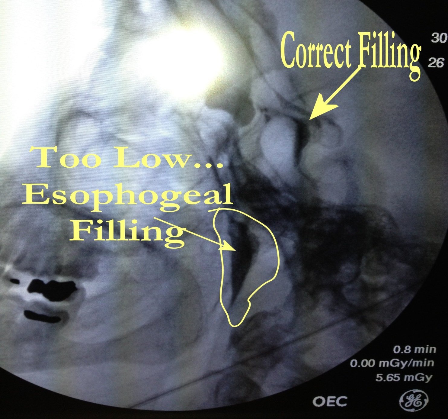Fluoroscopic filling study during a sphenopalatine ganglion block, labeled to contrast correct filling at the spheno-ethmoid recess with a too-low catheter position producing esophageal filling
