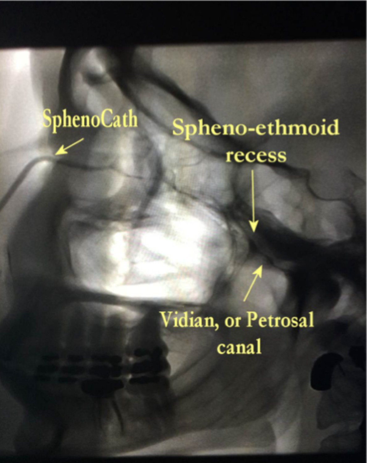 Lateral fluoroscopic view during a sphenopalatine ganglion block, labeled to show the SphenoCath [soft nasal catheter] in position, the spheno-ethmoid recess and the Vidian or petrosal canal